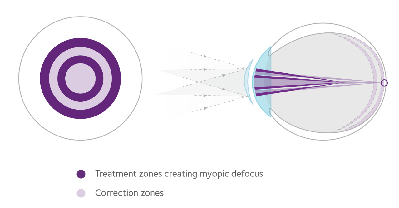 How MiSight works